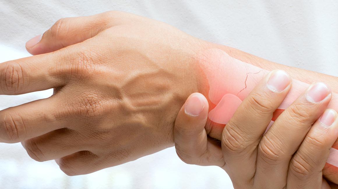 Dłoń w nadgarstku, na przekroju widać złamaną kość