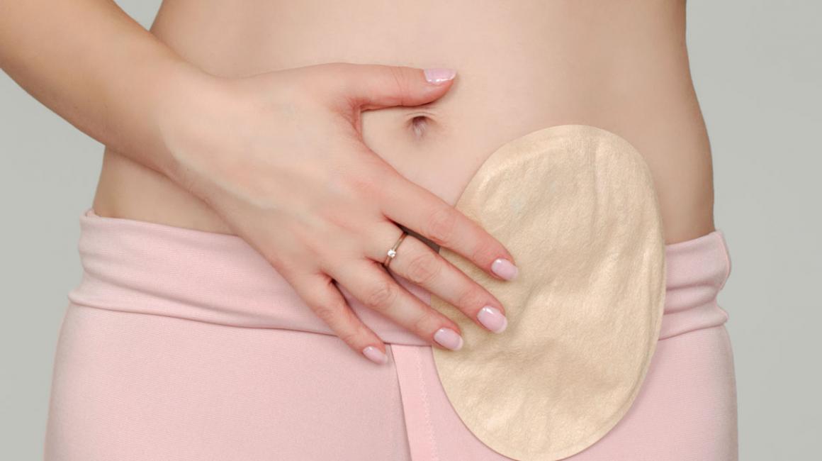 Widok z przodu na goły brzuch kobiety. Widać worek stomijny przymocowany do brzucha. Torba stomijna w kolorze skóry.