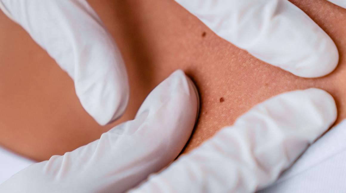 Zbliżenie na plecy. Ręce lekarza w białych rękawiczkach sprawdzają skórę pacjentki.