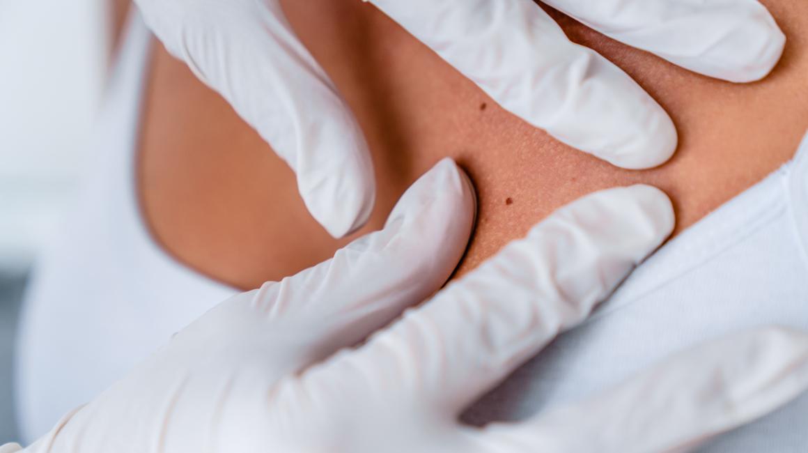 Zbliżenie na plecy. Ręce lekarza w białych rękawiczkach sprawdzają skórę pacjentki.