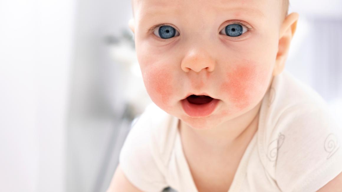 Niemowlak z wysypką na policzkach