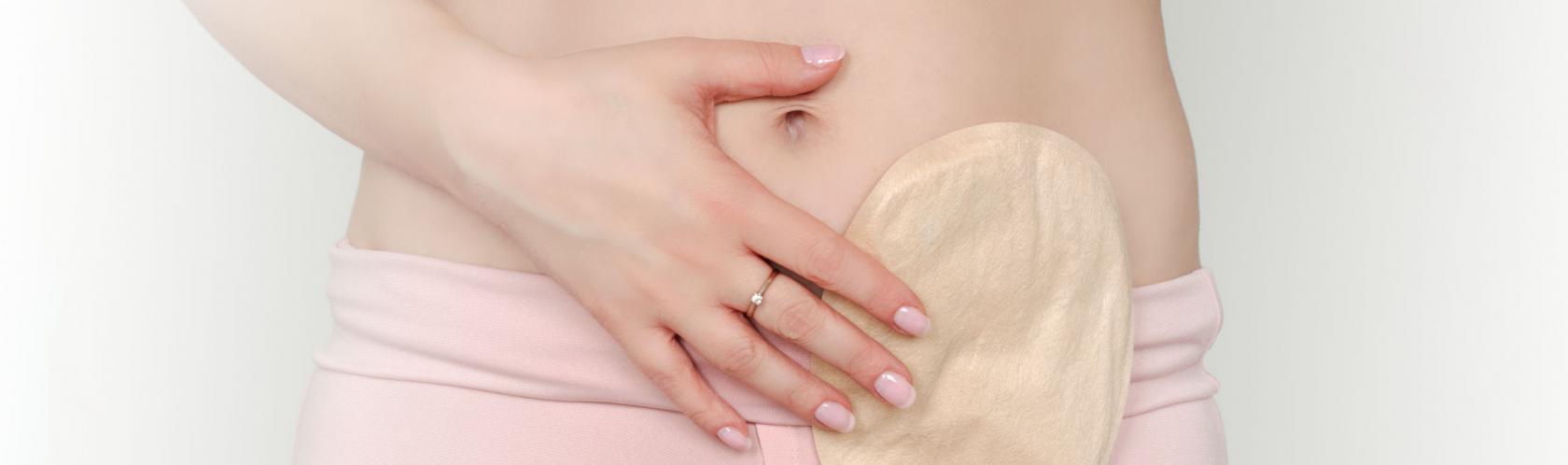 Widok z przodu na goły brzuch kobiety. Widać worek stomijny przymocowany do brzucha. Torba stomijna w kolorze skóry.