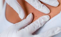 Zbliżenie na plecy. Ręce lekarza w białych rękawiczkach sprawdzają skórę pacjentki.