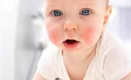 Niemowlak z wysypką na policzkach